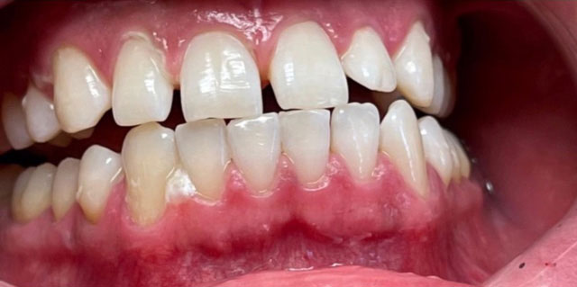 The image displays a close-up view of a person s mouth with teeth showing, some of which appear to be damaged or discolored, against a pinkish background that could be the interior of a mouth or lips.
