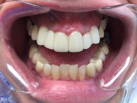 The image shows a person s mouth with teeth and gums, displaying an open-mouth smile, and appears to be taken from a dental perspective, possibly during a dental appointment.