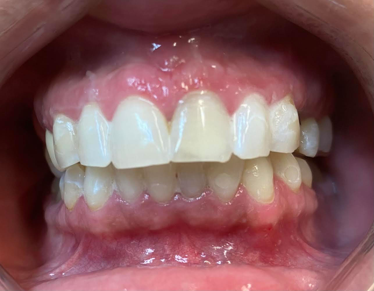 A close-up view of an open mouth with a prominent set of teeth, showcasing a pinkish gumline and a partial denture.