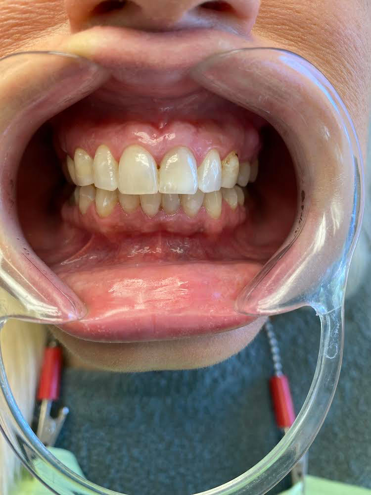 The image shows a person wearing an open-mouth orthodontic appliance with sharp edges, revealing teeth and gums, against a blurred background.