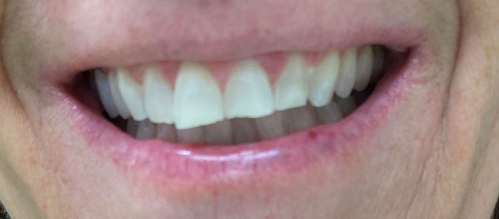 The image shows a close-up of a person smiling with their teeth visible, against a background that appears to be a light-colored wall.