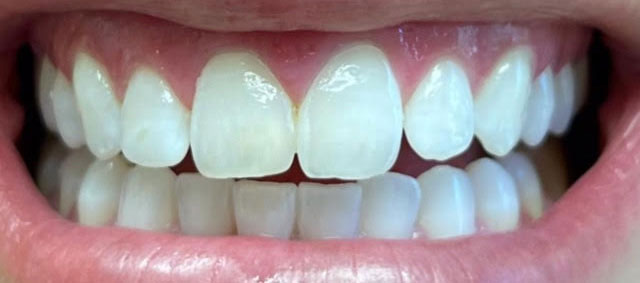 The image shows a close-up view of a person s teeth with a bright smile, focusing on the lower front teeth and part of the upper lip.