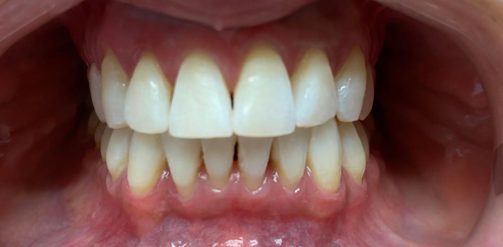 The image shows a close-up view of a person s teeth with a focus on a large gap between two front teeth, which are prominently displayed.