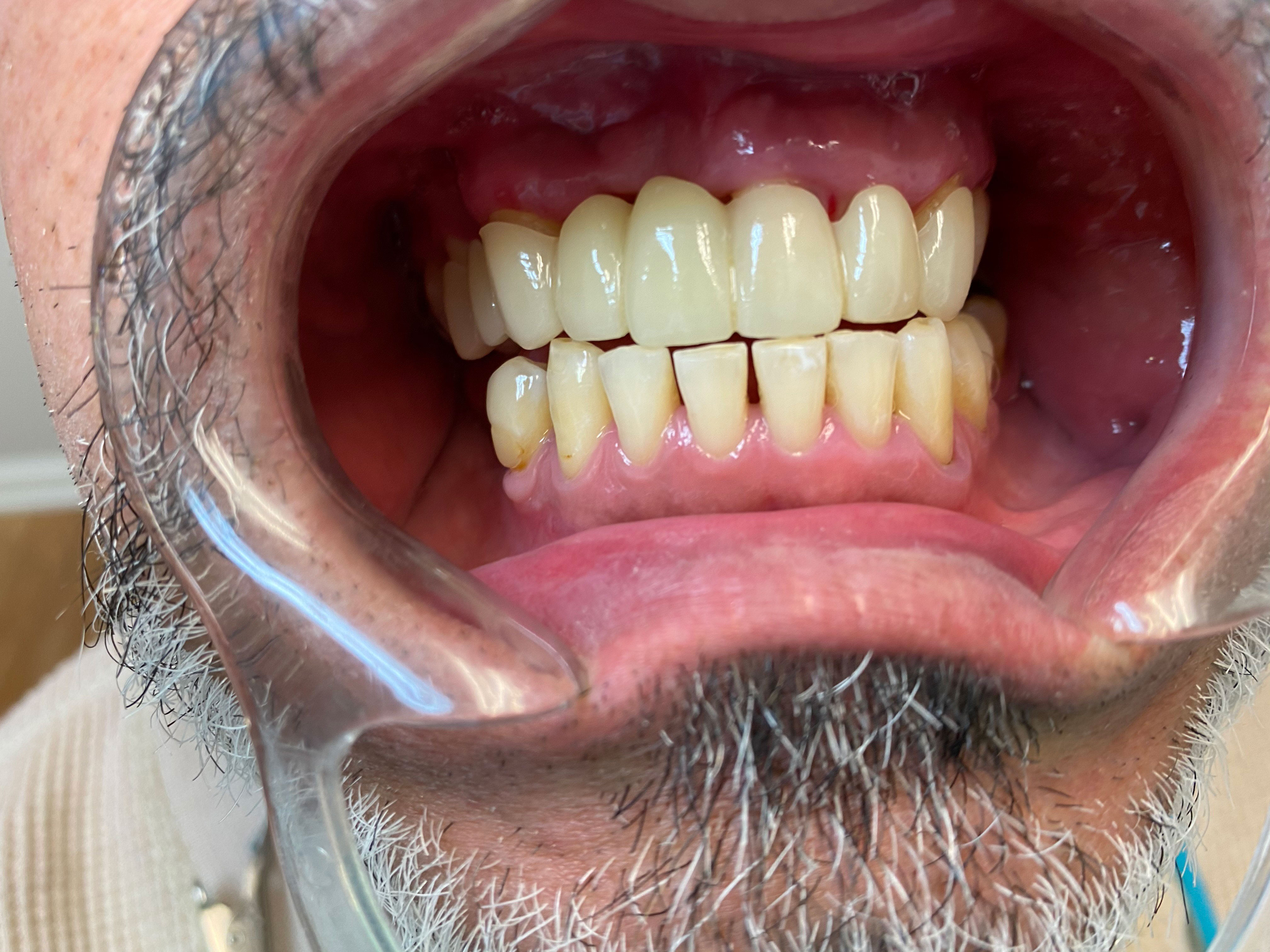 The image shows a person with an open mouth displaying their teeth, which appear yellowed and possibly stained, set against a blurred background that suggests a dental or medical setting.
