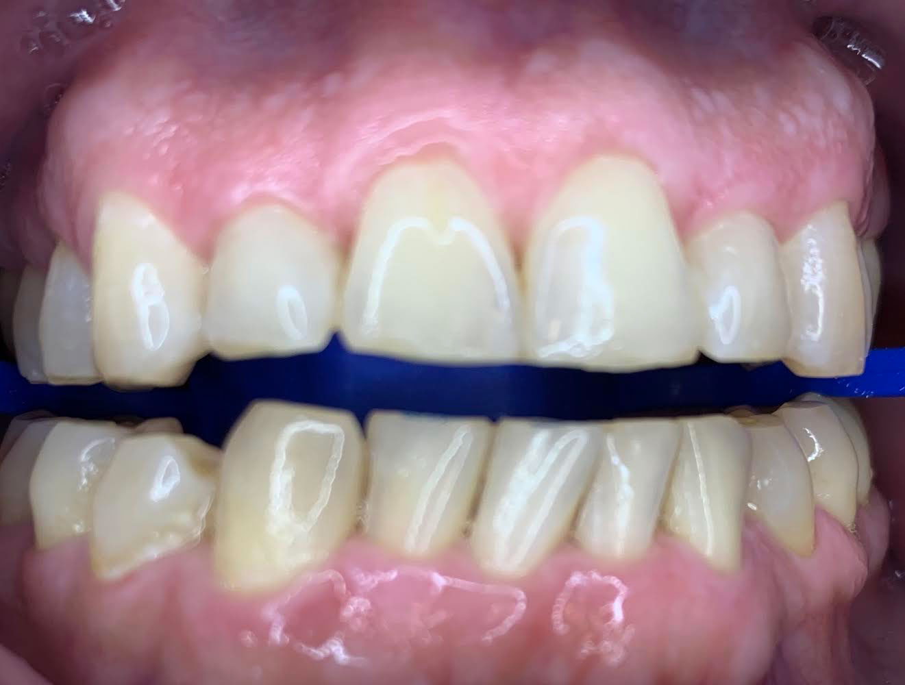 The image shows a close-up view of a person s teeth with an upper and lower set of dental implants, featuring a pink gum line and blue markers on the teeth.