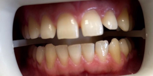 The image shows a close-up view of a person s teeth with a noticeable gap between them, which is highlighted by an open mouth revealing the interior of the mouth.