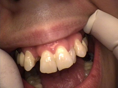 The image shows a person s mouth with a large gap between the teeth, revealing an unhealthy oral condition, possibly due to decay or gum disease.