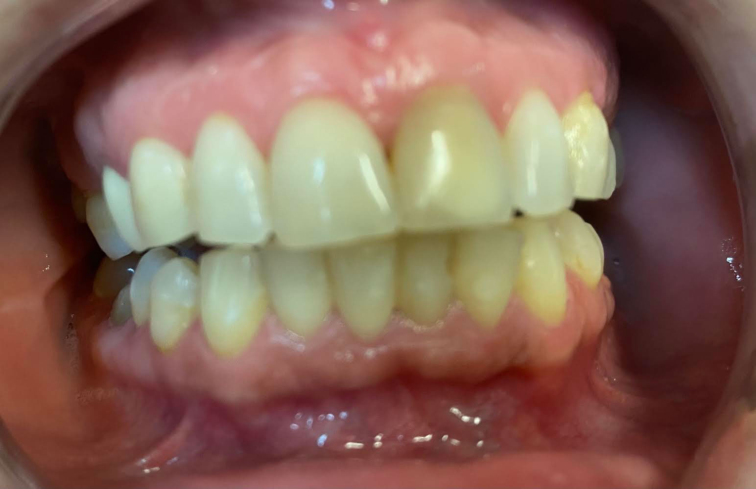 The image shows an open mouth displaying yellowed teeth with a focus on the front teeth, which appear discolored due to dental issues such as staining or decay.