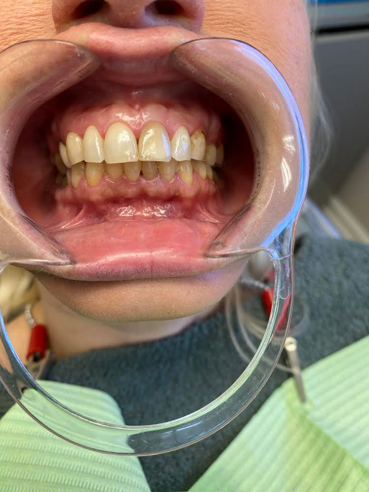 The image depicts a person with an open mouth wearing dental braces, sitting in a dental chair with medical equipment around them, likely during a dental procedure.