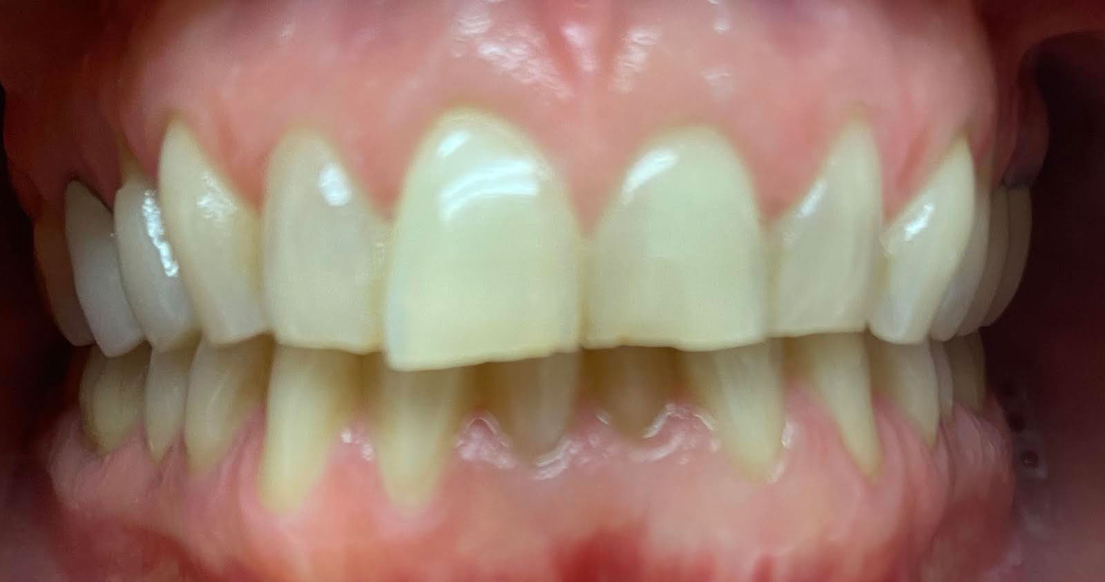 The image displays a close-up view of a person s teeth with a focus on yellowing and staining, set against a blurred background that appears to be a mouth.