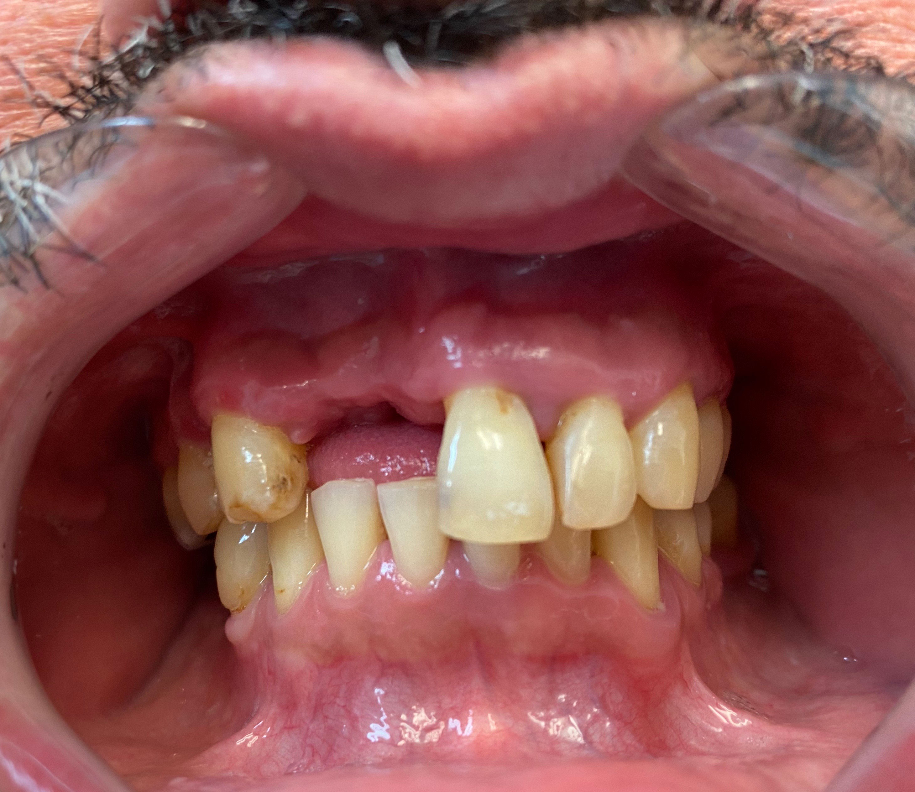 The image shows a close-up view of an individual's mouth with multiple teeth missing and yellowed teeth remaining, revealing a dental condition known as tooth decay or cavities.
