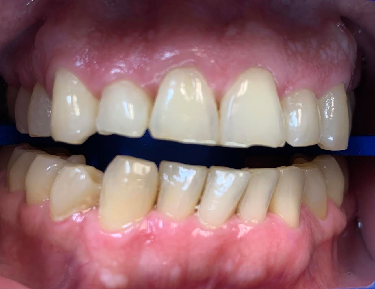 The image shows a close-up view of a person s teeth with a focus on a noticeable pinkish gum line, displayed against a blue background.