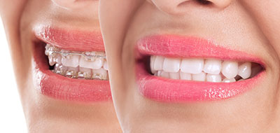 A split-screen image showing two different views of a person s face with a bright smile.