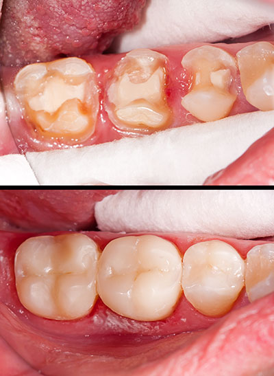 The image shows a close-up view of an open mouth with visible teeth, gums, and tongue, highlighting dental issues such as discoloration and decay, with a focus on oral hygiene and potential treatment options.