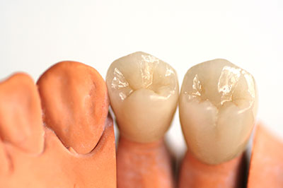 The image shows a pair of human teeth with visible enamel wear on either side, placed next to each other against a white background.