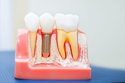 The image shows a dental model with various teeth components, including crowns and bridges, displayed on a pink base, with a screw visible on one of the models.