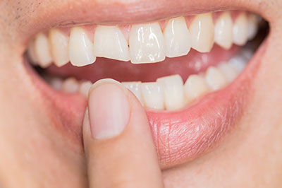 The image shows a person holding their finger near their teeth while smiling broadly at the camera.