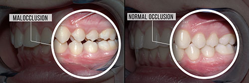 The image shows two photos side by side of a person s mouth before and after dental treatment, highlighting the transformation from malocclusion to normal occlusion.