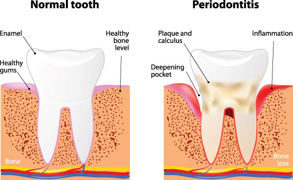 The image is a medical illustration showing a normal tooth on the left, followed by an enlarged tooth with periodontitis, indicating bone loss around the teeth, and finally a severely damaged tooth with signs of infection and inflammation, suggesting advanced gum disease.