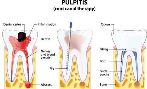 The image shows a diagrammatic representation of pulpitis with labels indicating various parts of the tooth and surrounding tissue, including the root canal, dental caries, inflammation, filling, and a cross-section view highlighting the affected pulp area.