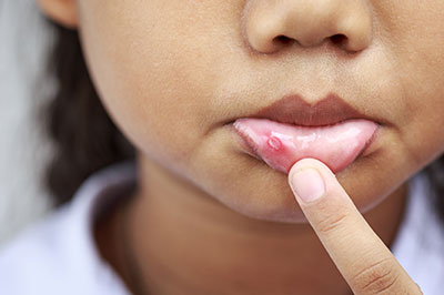 The image shows a young child with their finger on their lips, displaying a noticeable red bump on their bottom lip.