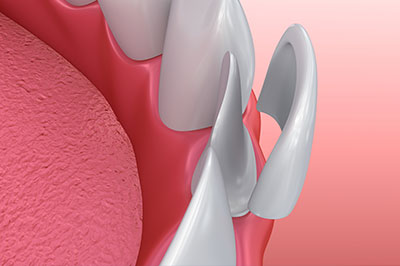 The image shows a close-up view of a dental implant with a metal fixture protruding from a pink oral tissue, set against a red background.