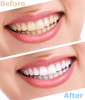 The image shows a side-by-side comparison of a person s teeth before and after a dental treatment, with a smile and clear teeth on the right indicating the result of the procedure.